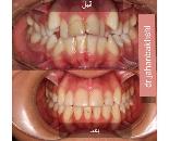ارتودنسی نامرئی در نیروهوایی