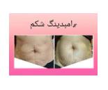 مرکز امبدینگ شکم در کرج